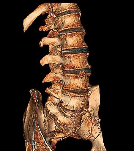 МСКТ и СКТ позвоночника, что это, чем отличается от КТ